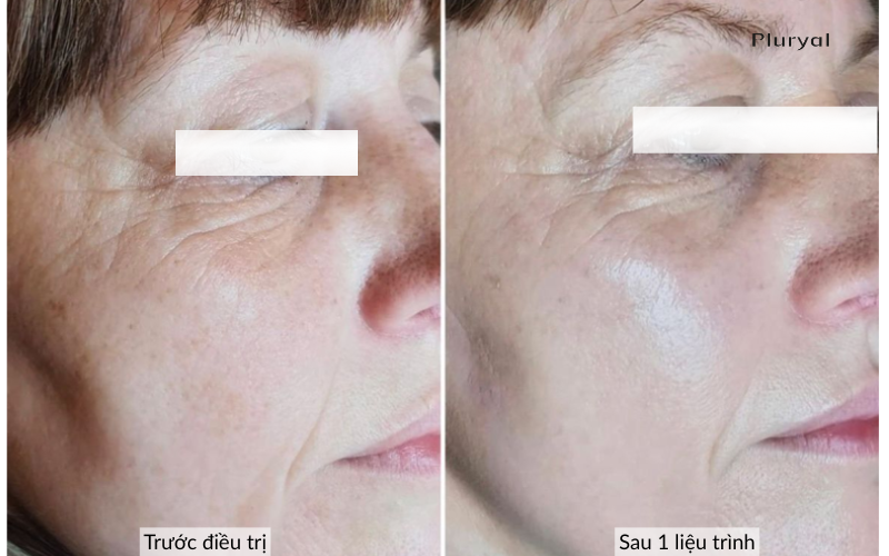 Khách hàng trước và sau điều trị tình trạng da chảy xệ, da mất nước với Pluryal Densify